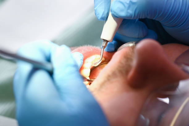Best Emergency Root Canal Treatment in Elkins, WV